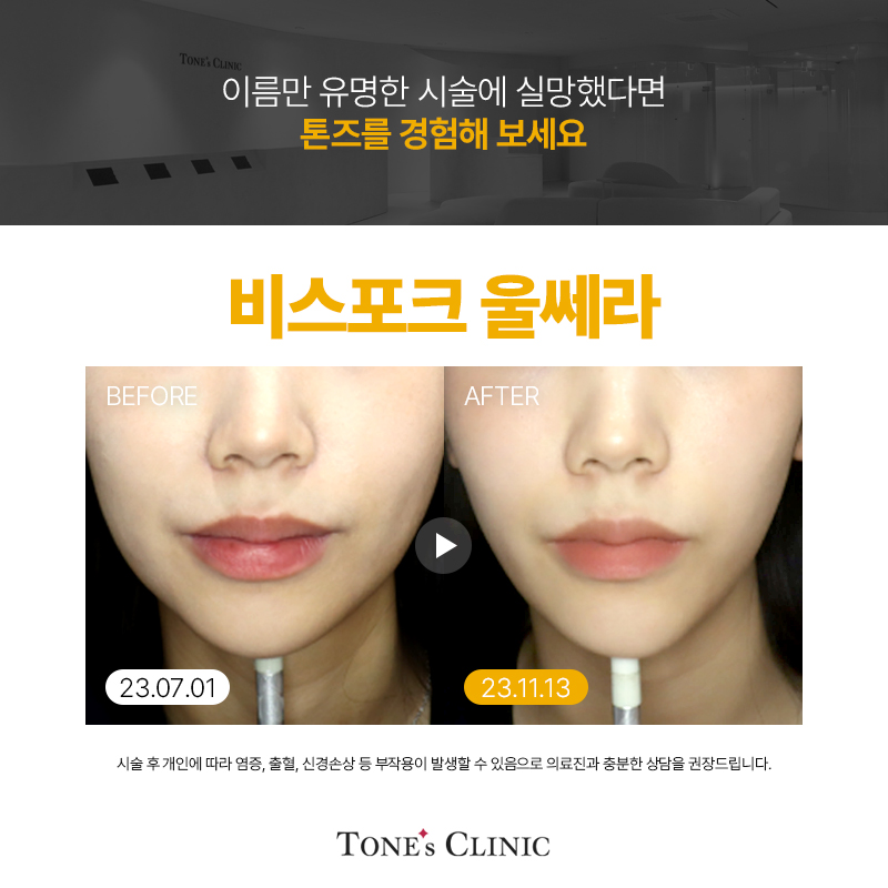 비포크울쎄라