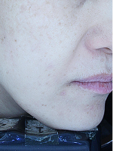 피코슈어/플러스+엑셀브이+줌패스