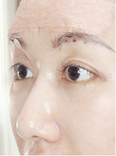 이마거상 실리프팅