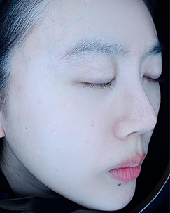 색소토닝2