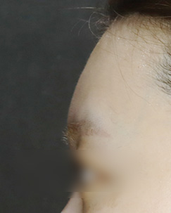 이마필러2